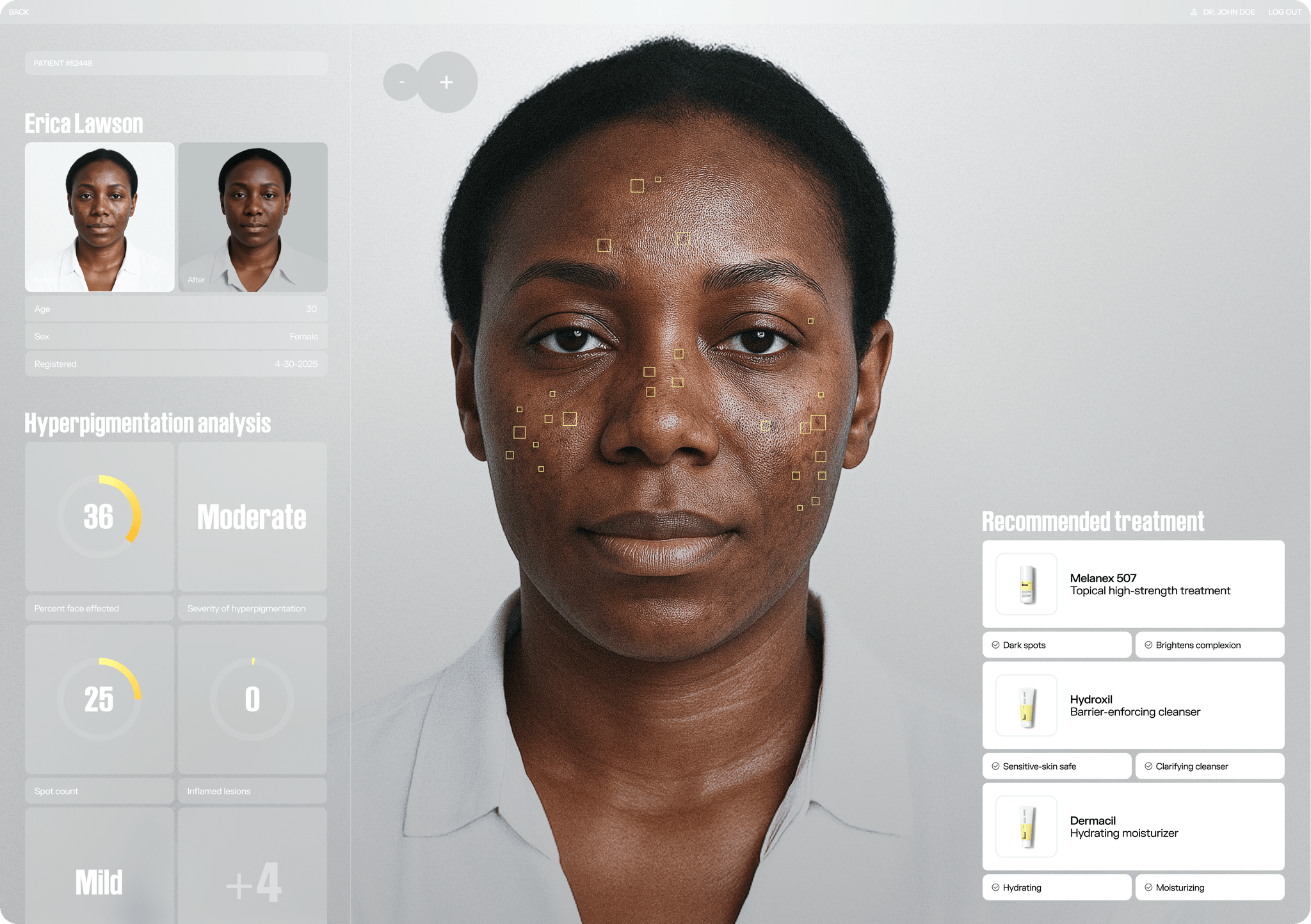Hyperpigmentation Before