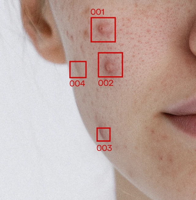 Inflammatory acne